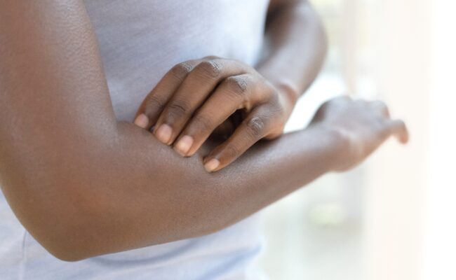Climatic Hazards Affecting People of Color Linked to Aggravation of Atopic Dermatitis