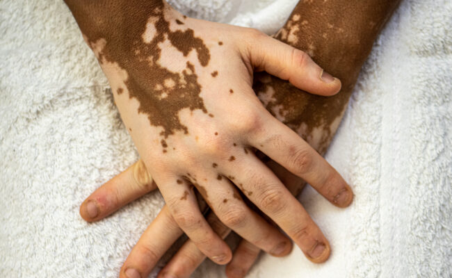 Vitiligo Patients Have Significantly Higher Health Care Costs