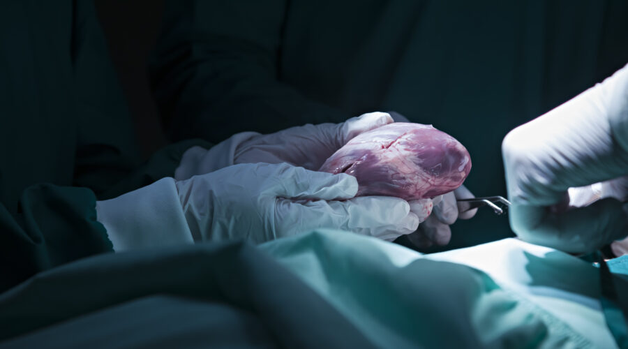 Black Men May Be Less Likely to Receive Life-Saving Heart Transplants